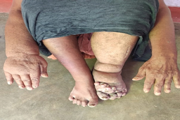 Right upper and left lower lymphoedema.
